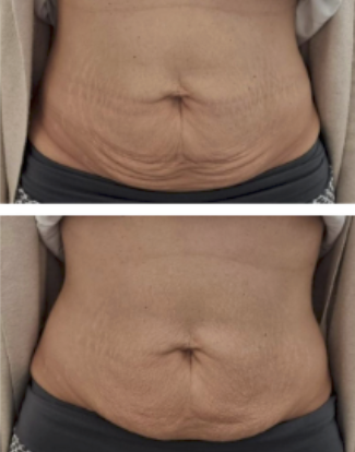 Abdominal contouring — skin tightening protocol