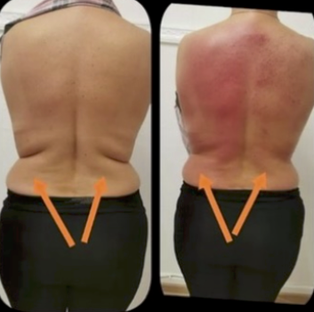 Flank & back — targeted fat reduction